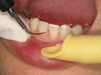 1.超音波にて歯石除去
