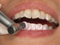 4.歯面研磨、数種類のカップ、ペイストから患者さんに合わせて、歯面についた小さな傷をツルツルにトリートメント