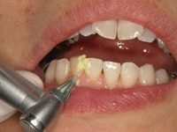 4.歯面研磨、数種類のカップ、ペイストから患者さんに合わせて、歯面についた小さな傷をツルツルにトリートメント